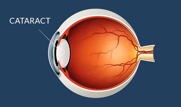 Cataract Surgery Farmington Hills | Cataracts Diagnosis West Bloomfield Township