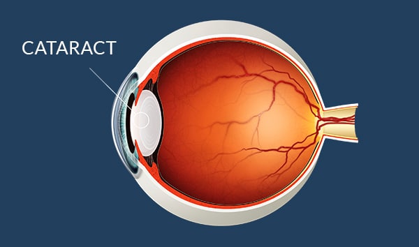 cataract-sm