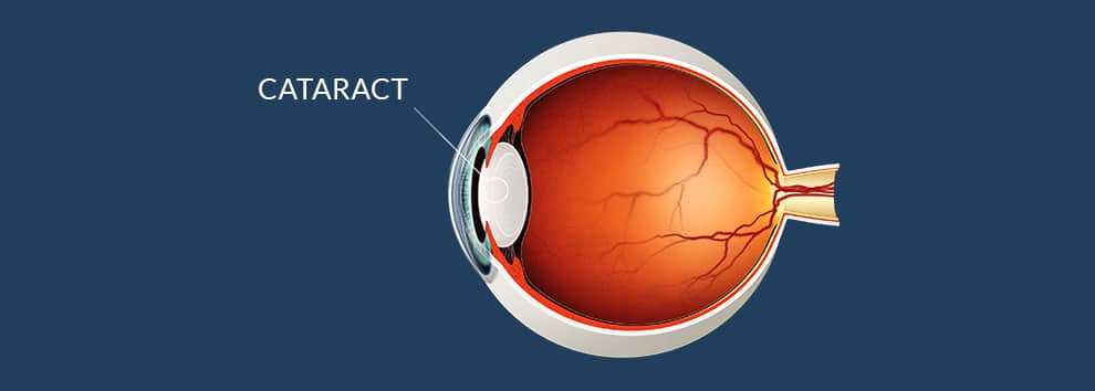 diagram of the human eye, showing a cataract