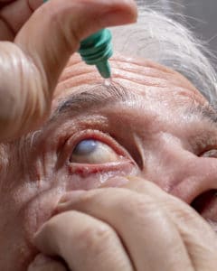 Self-instillation of eye drops in patients with glaucoma eyes. An elderly man with glaucoma.