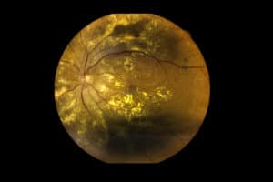 View inside human eye disorders showing retina, optic nerve and macula Severe age-related macular degeneration. 